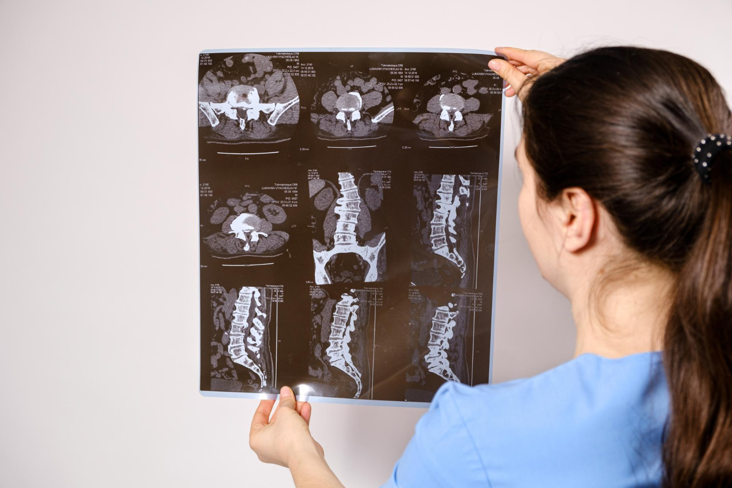 Traumatic Scoliosis Car Accident Settlement