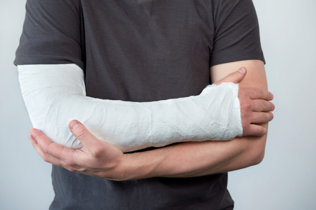 Man's arm with plaster cast